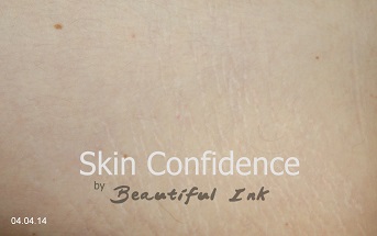 Stretch Marks after MCA Micro needling